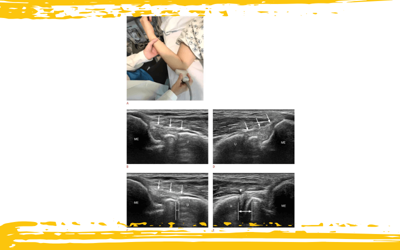 2. Diagnostico diferencial codo nervio cubital 1.png